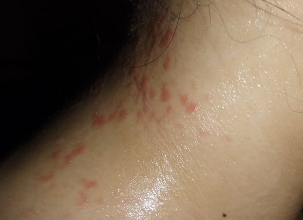 mild poison sumac rash. The rashes are redder than the