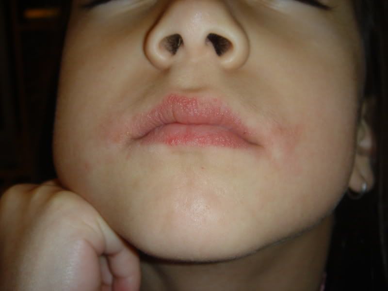 Skin rash and Swollen lips: Common.
