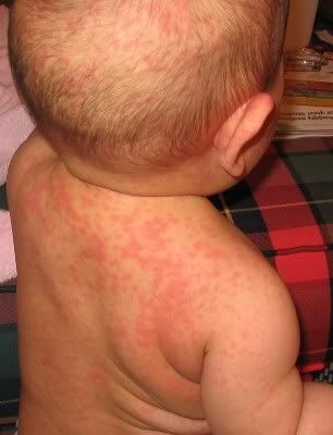 Severe Allergy: Symptoms and Treatment - Healthline