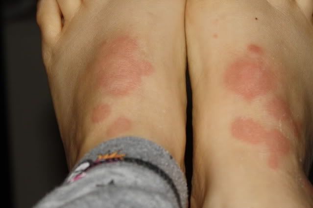 heat rash on foot pictures #9