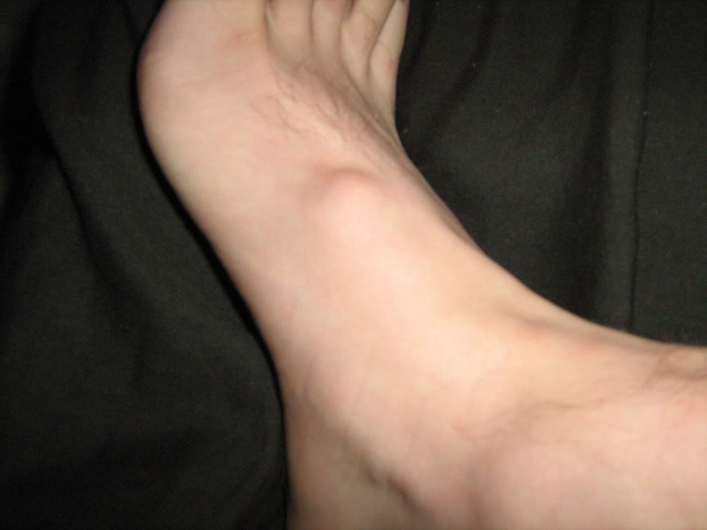 bumps on top of foot